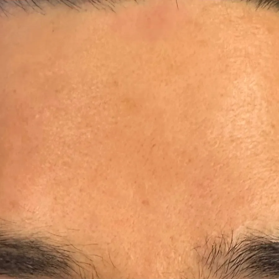 After: forehead lines