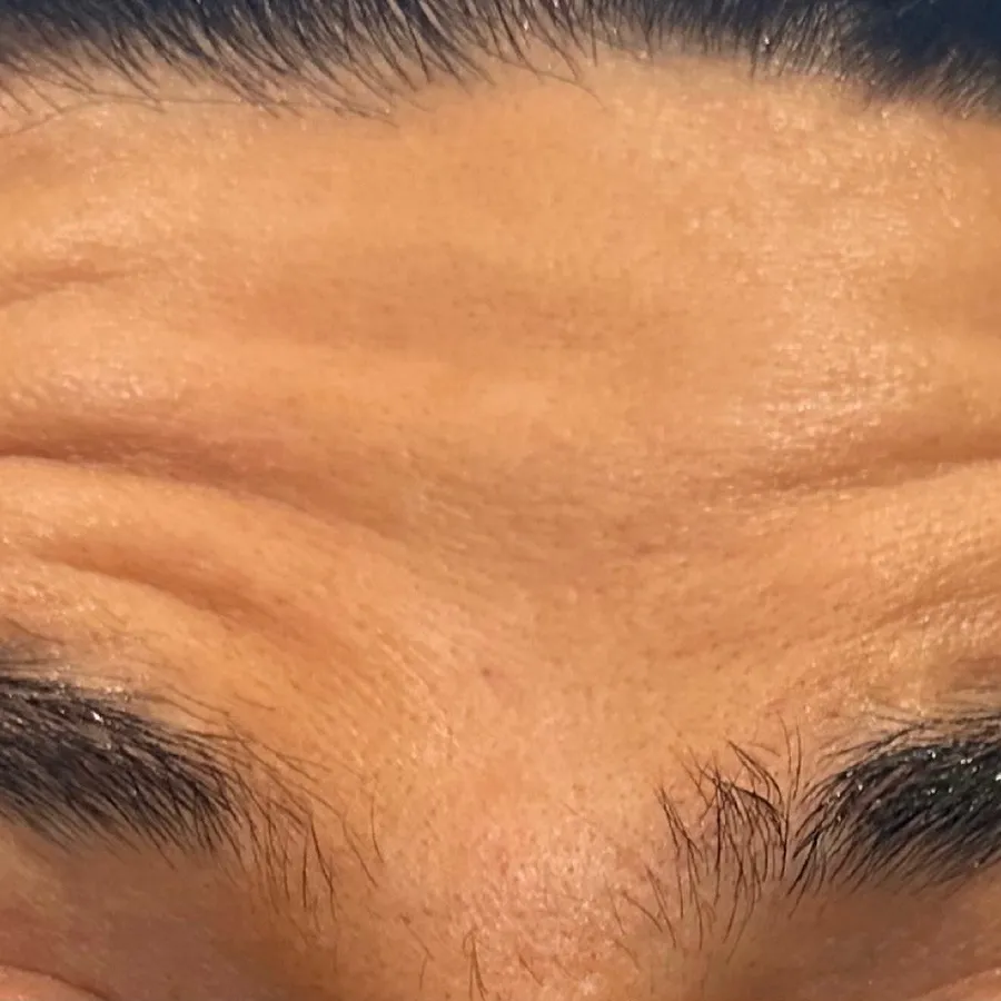 Before: forehead lines