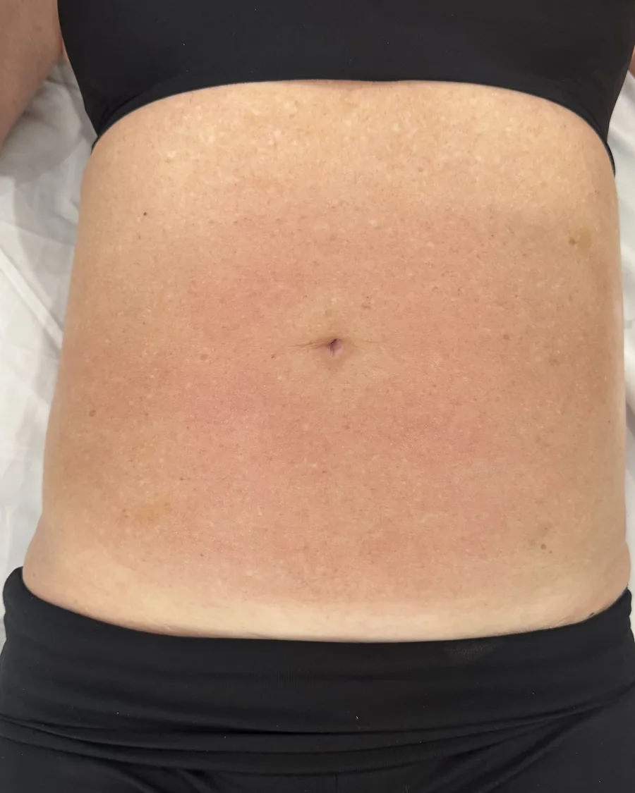 After: abdomen, right after one session