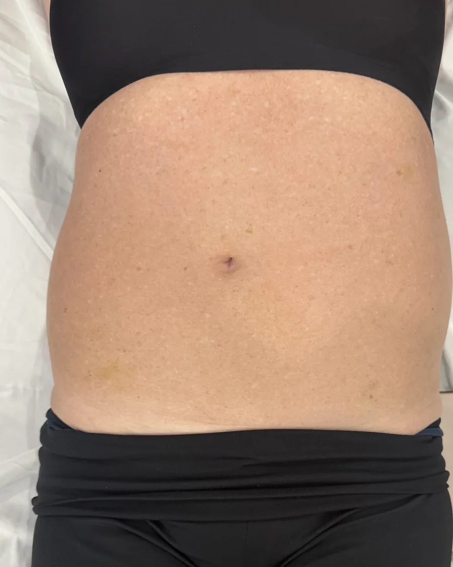 Before: abdomen, right after one session