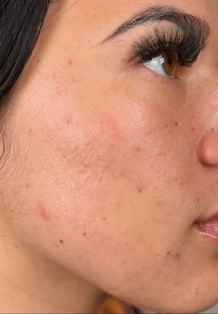 After: breakouts and redness