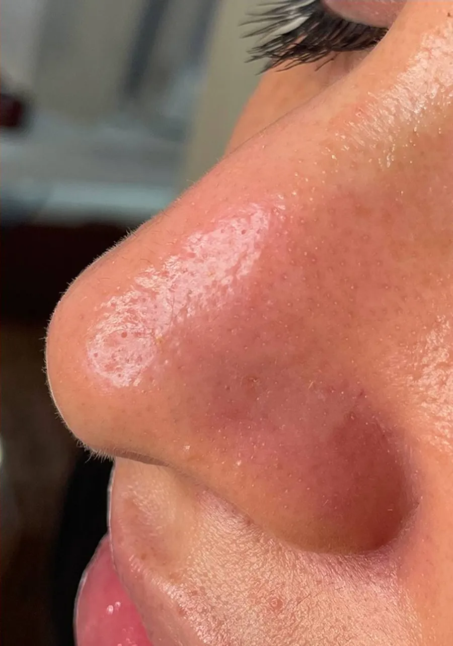 After: clogged pores