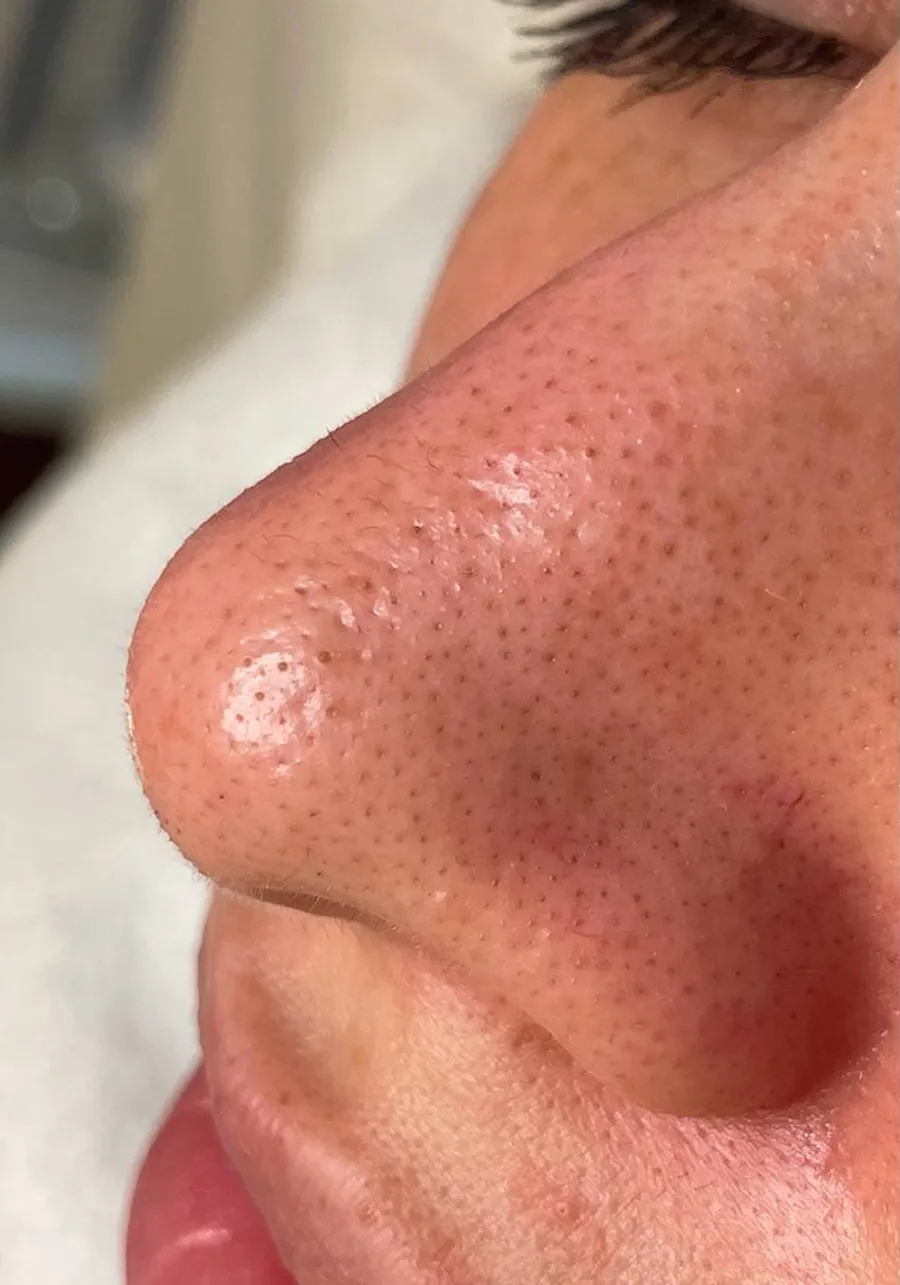 Before: clogged pores