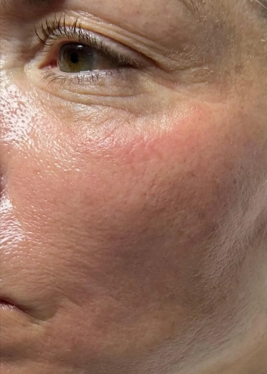 After: fine lines and texture