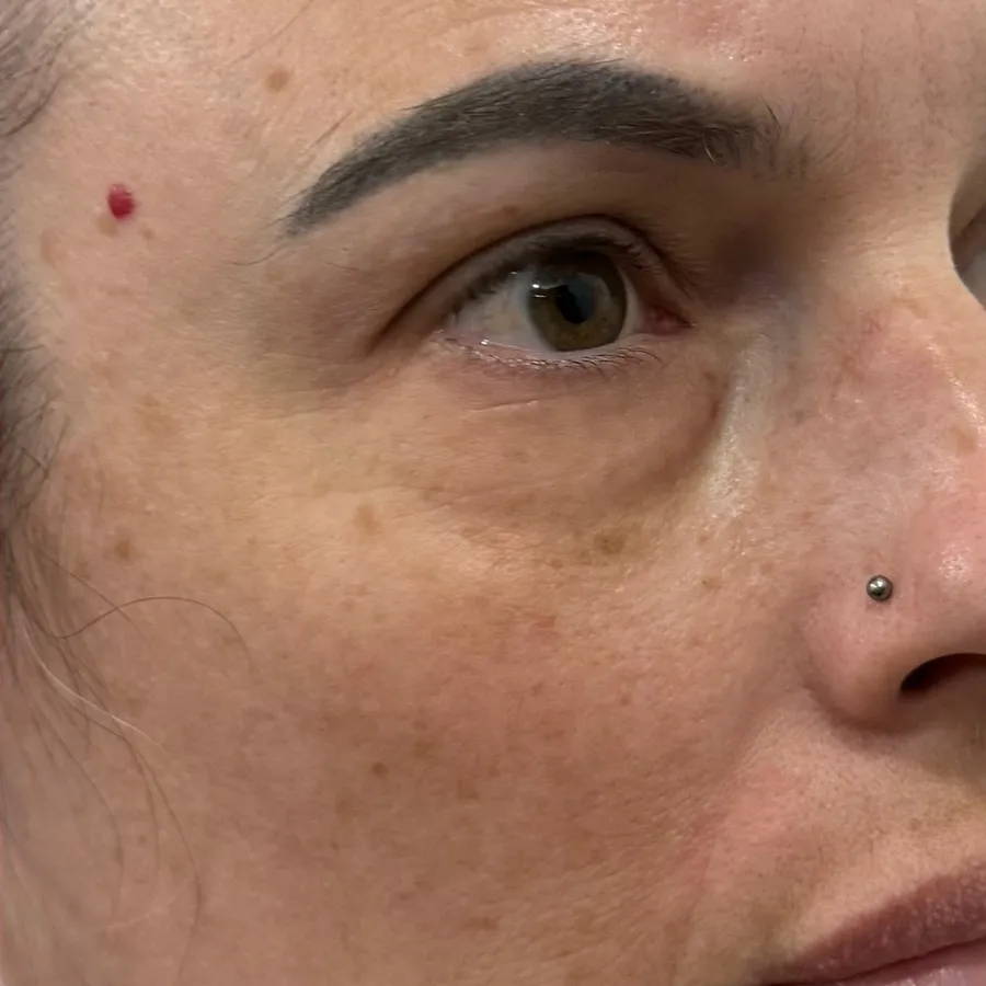After: brown spots