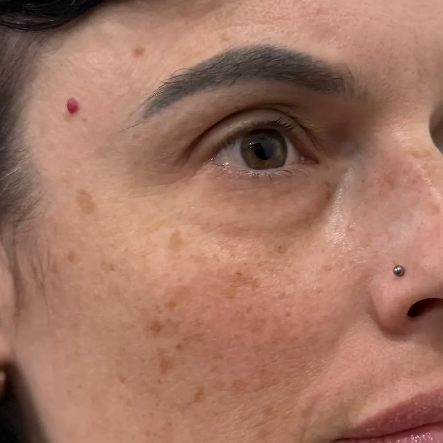 Before: brown spots
