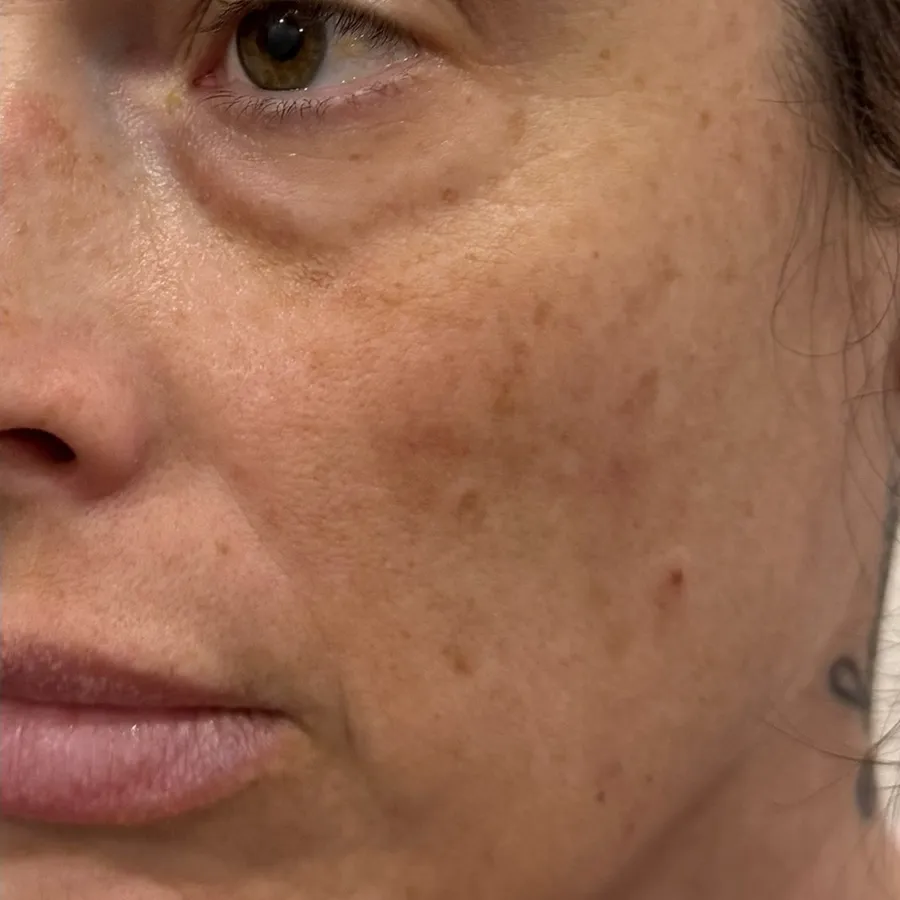 After: sun spots