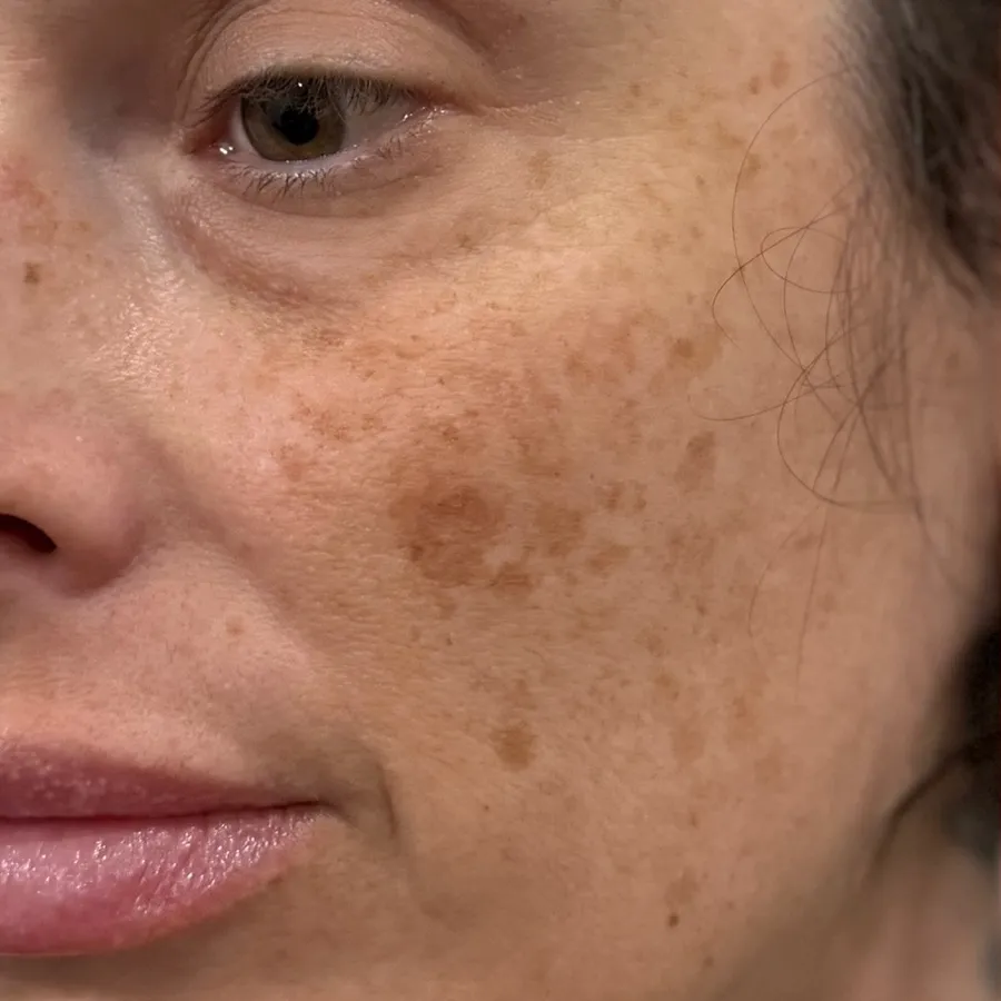 Before: sun spots