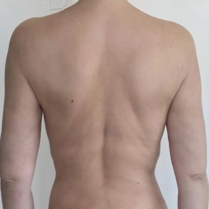 After: back and arms