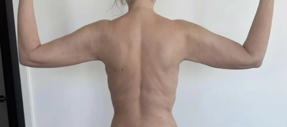 After: upper arms, raised