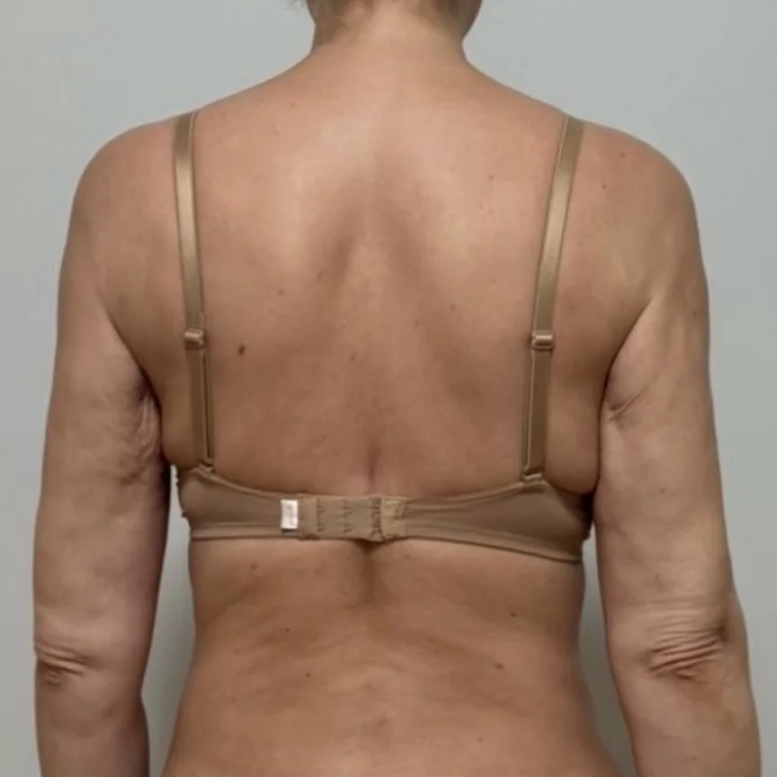 Before: back and arms