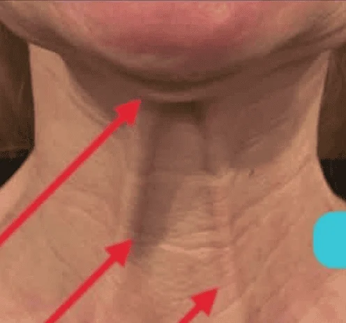 Before: neck